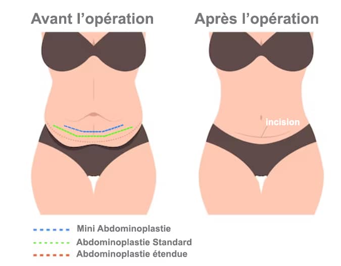 Abdominoplastie Tunisie Intervention Compl Te