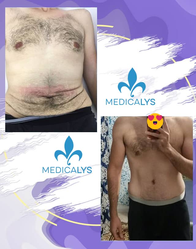 tummy tuck man in Tunisia before after