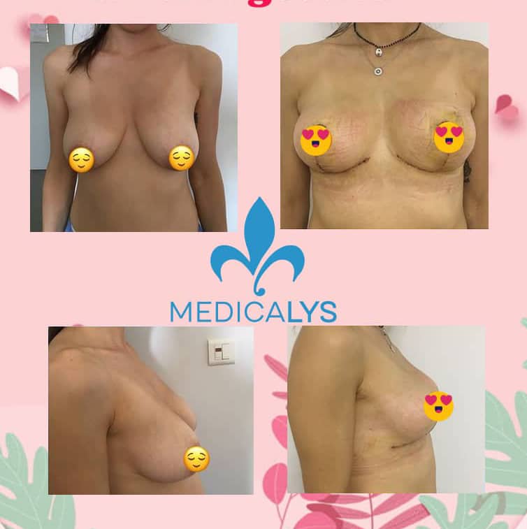 Lifting des seins en Tunisie avant après + implants mammaires