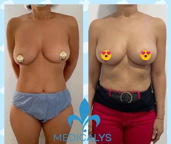 Lifting des seins en Tunisie avant après avec implants mammaires