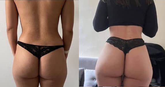 Lipofilling fessier Tunisie avant après