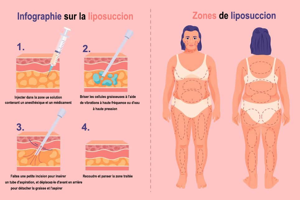 LIPOSUCCION-TUNISIE Medicalys