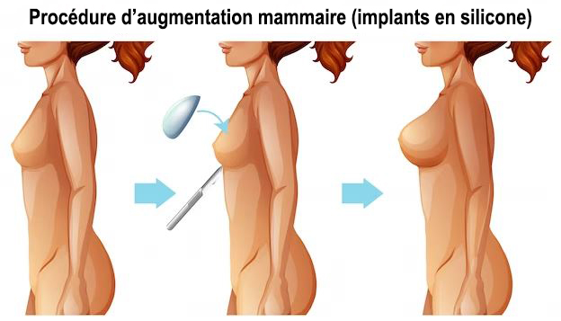 Femme Tenant Un Implant Mammaire En Silicone Pour Une Augmentation