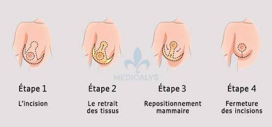 Réduction mammaire Tunisie Avant Après