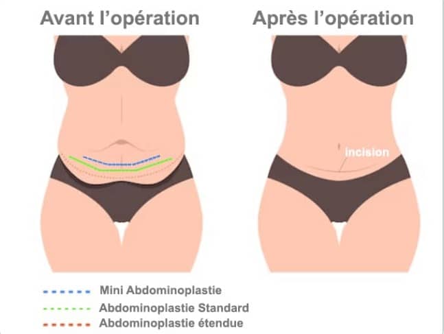 Abdominoplatie Tunisie