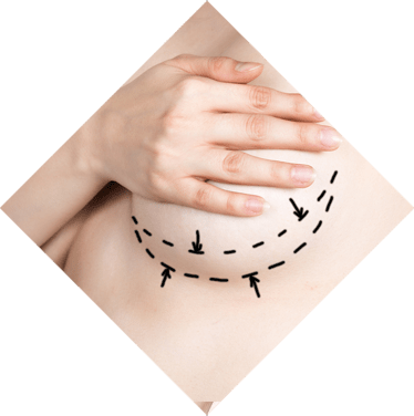 Lifting des seins