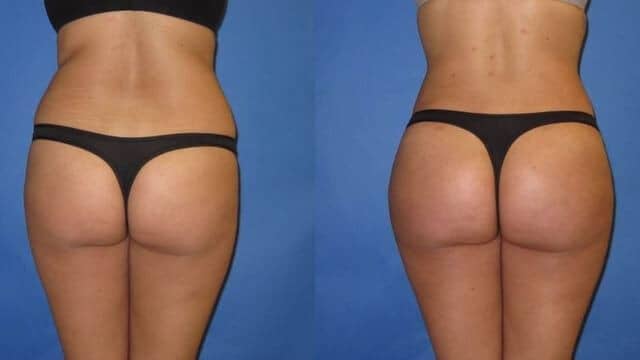 Lipofilling fessier Tunisie