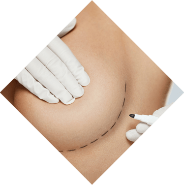 Lipofilling des seins