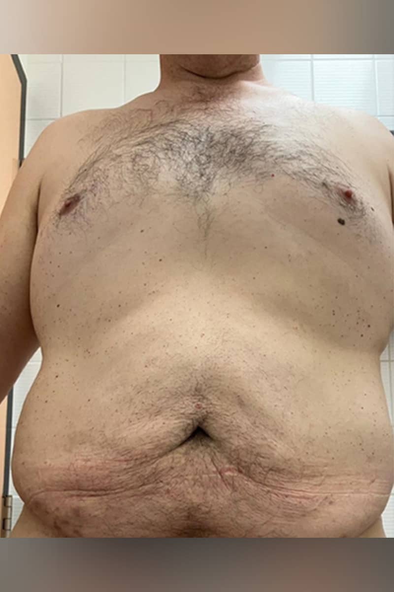 Abdominoplastie Tunisie
