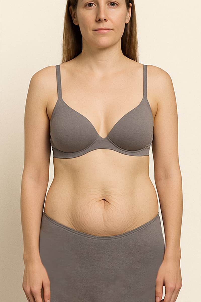 Abdominoplastie Tunisie