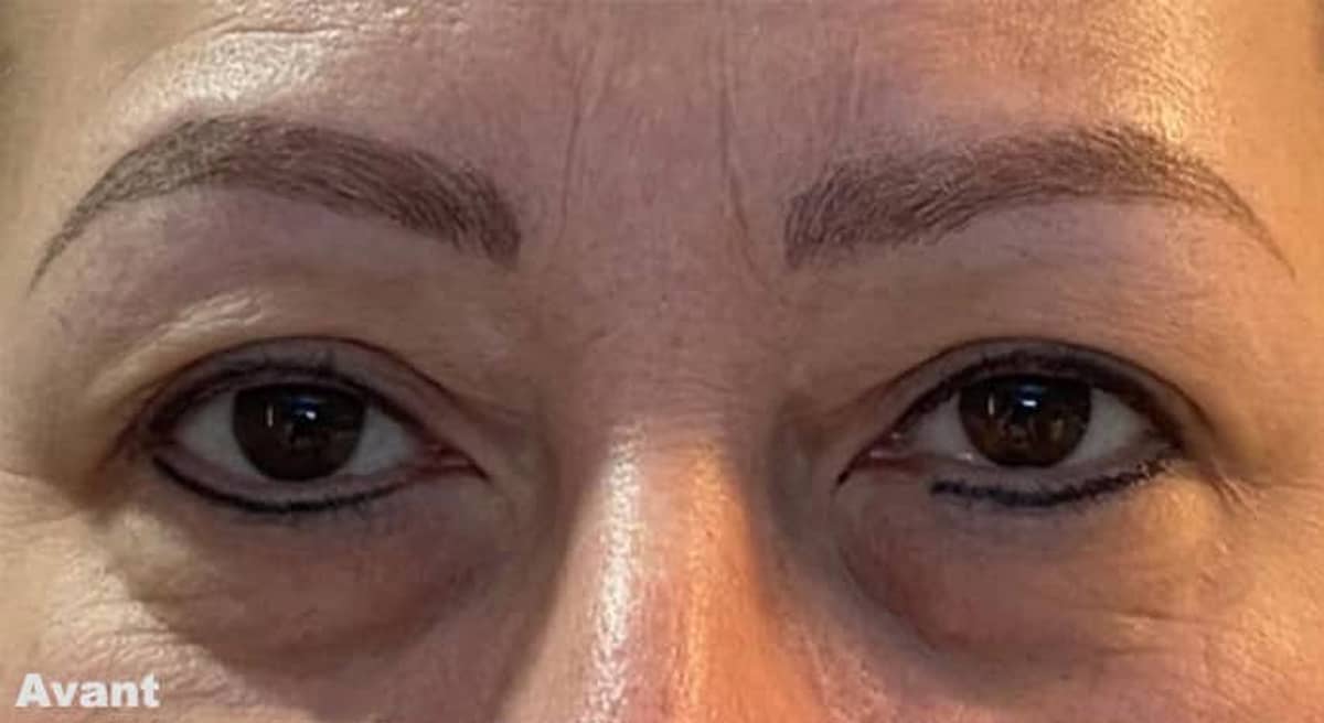 Blepharoplastie Tunisie