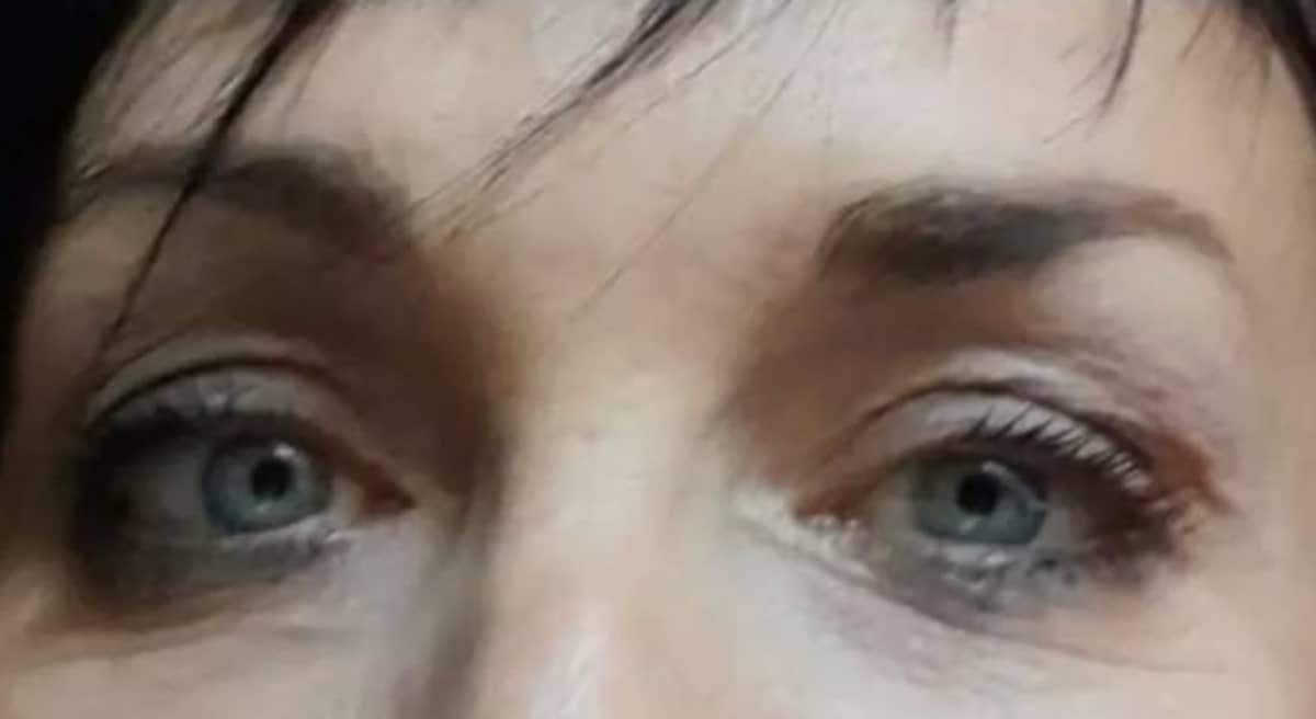 Blepharoplastie Tunisie