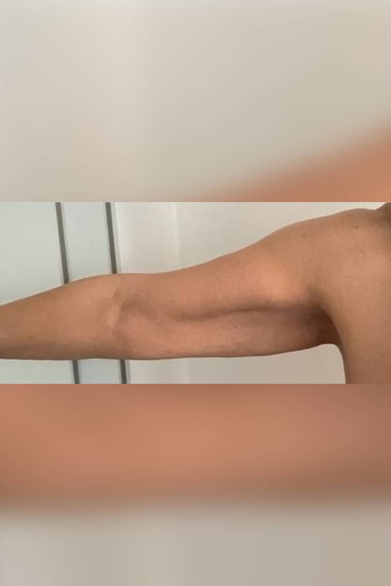 lifting des bras Tunisie