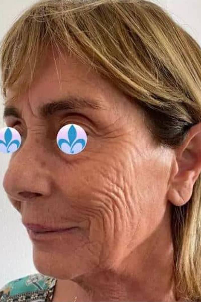 lifting cervico facial Tunisie