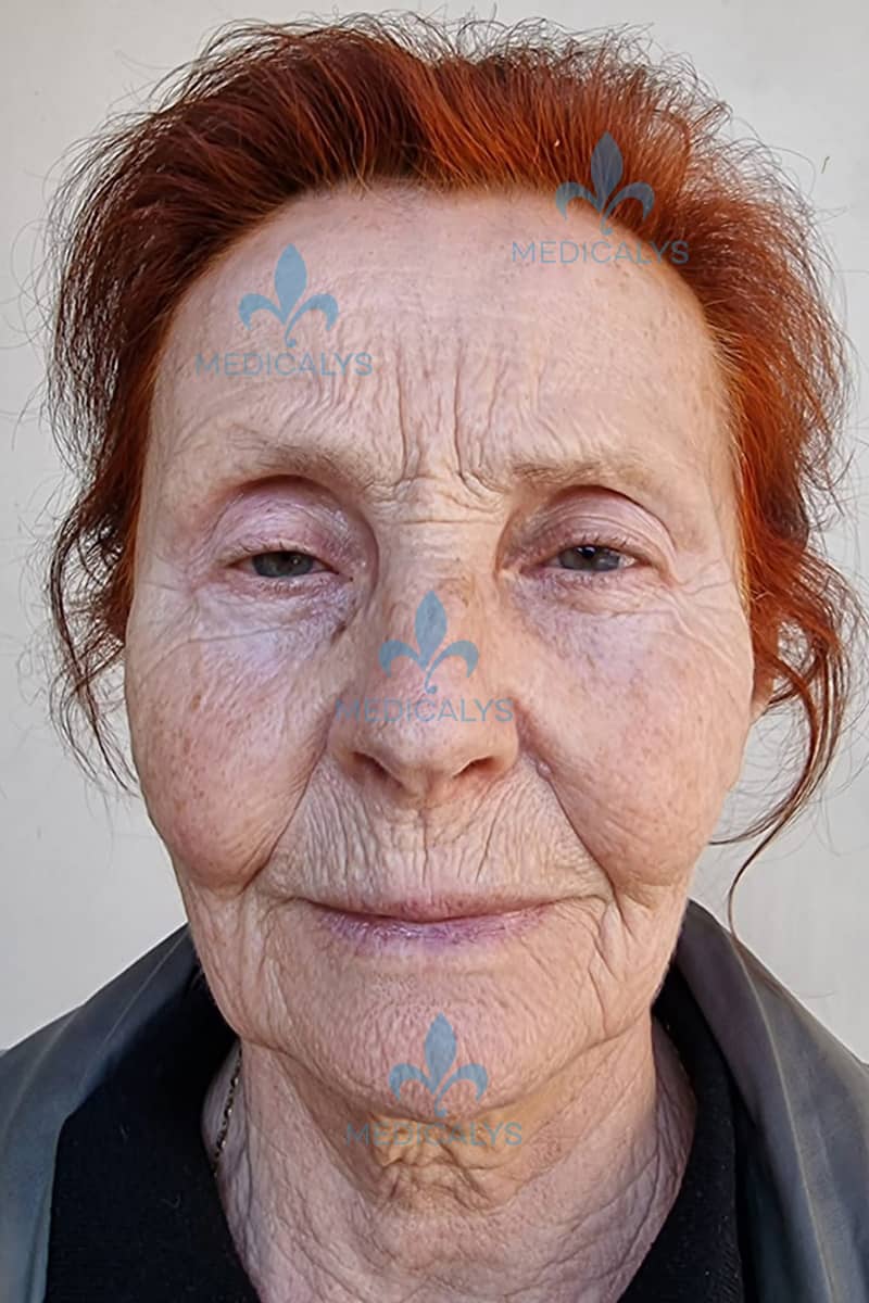 prix lifting cervico facial Tunisie