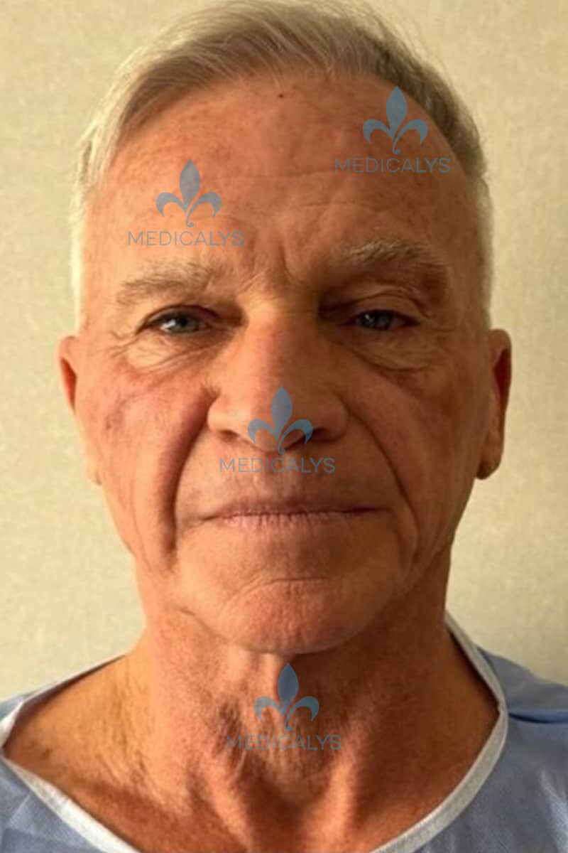 lifting cervico facial Tunisie