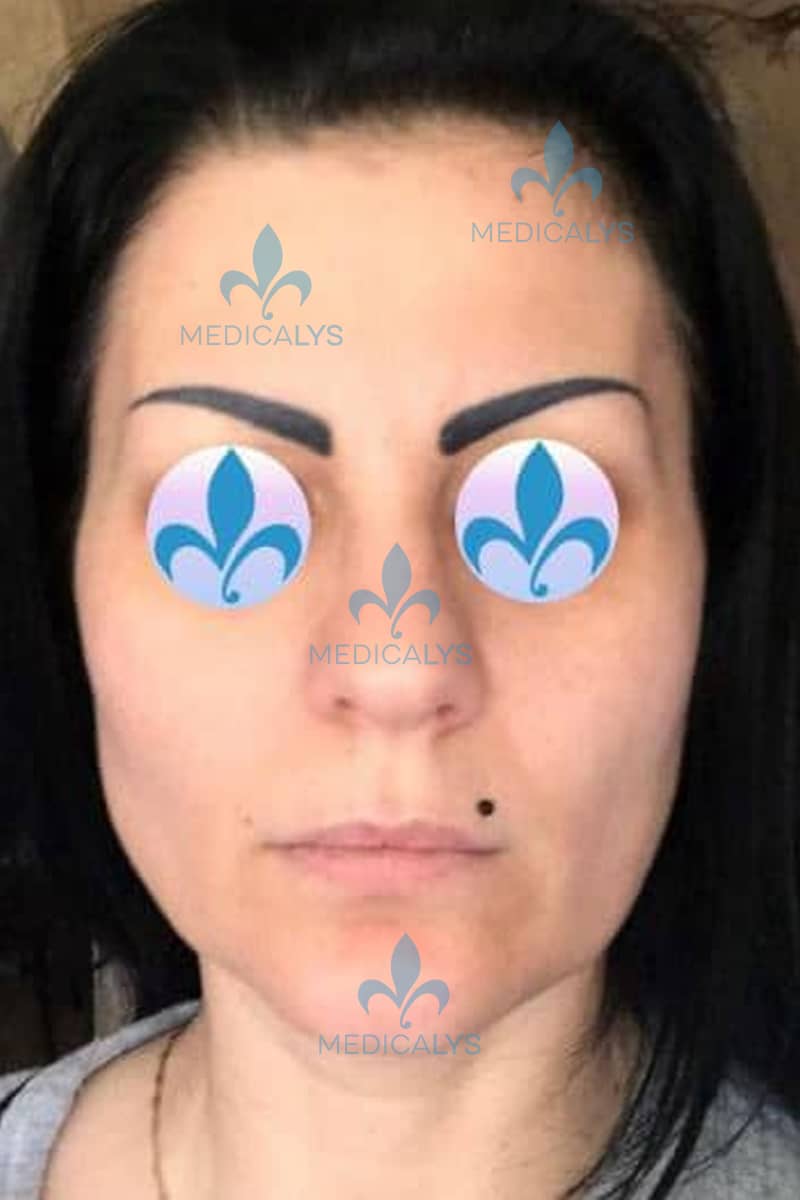 prix lifting cervico facial Tunisie