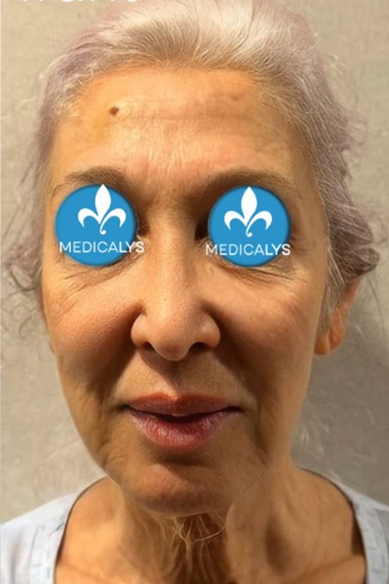 lipofilling visage Tunisie