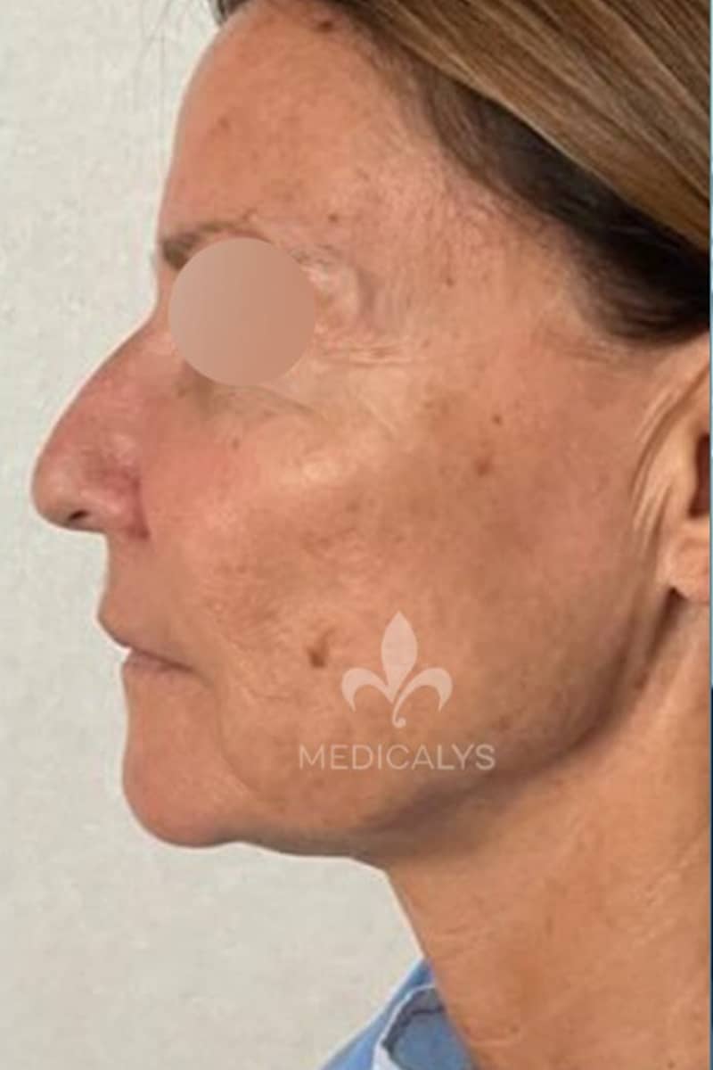 lipofilling visage Tunisie