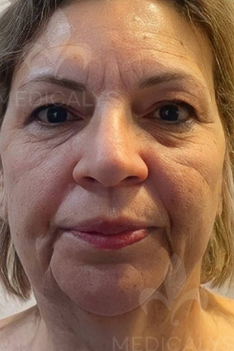 lipofilling visage Tunisie