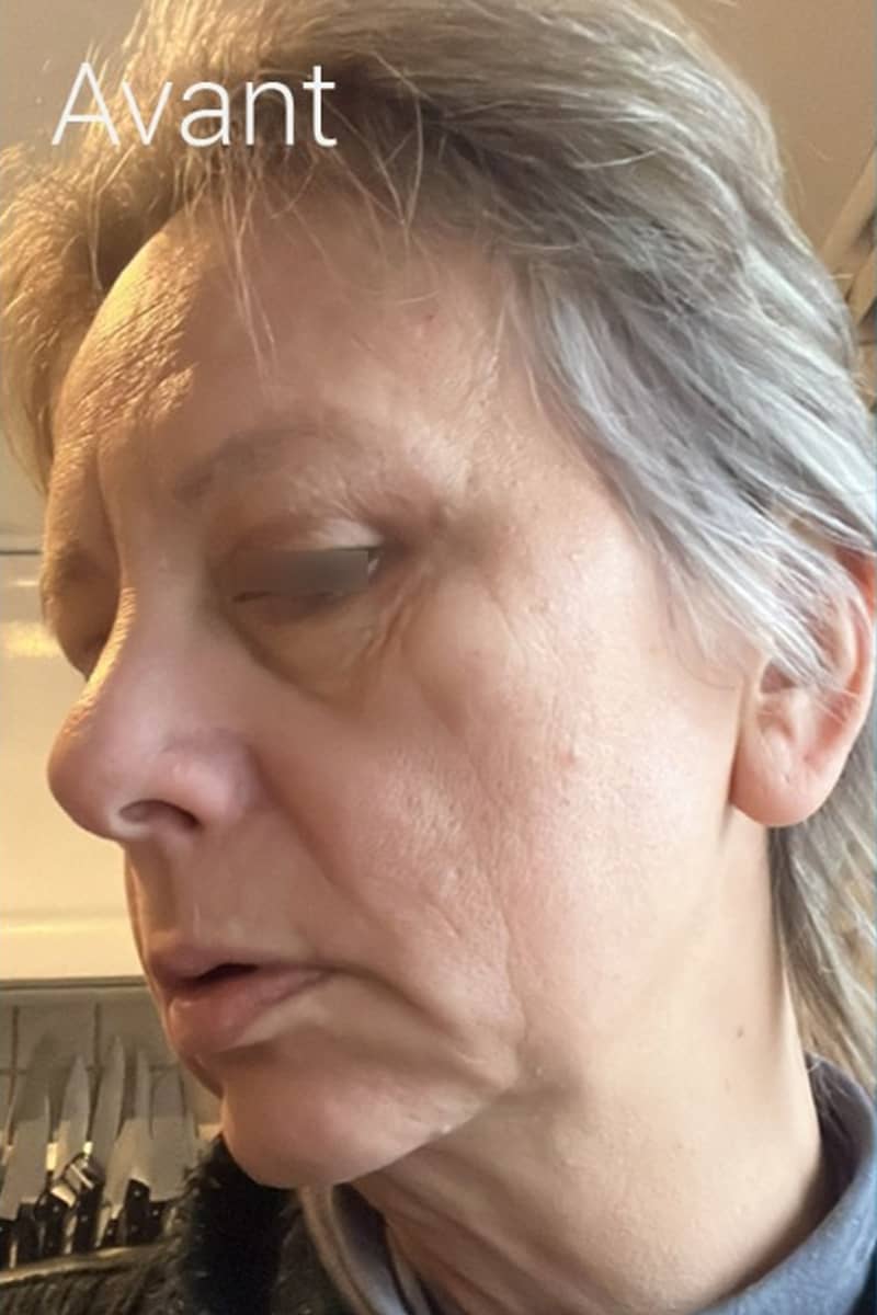 lipofilling visage Tunisie