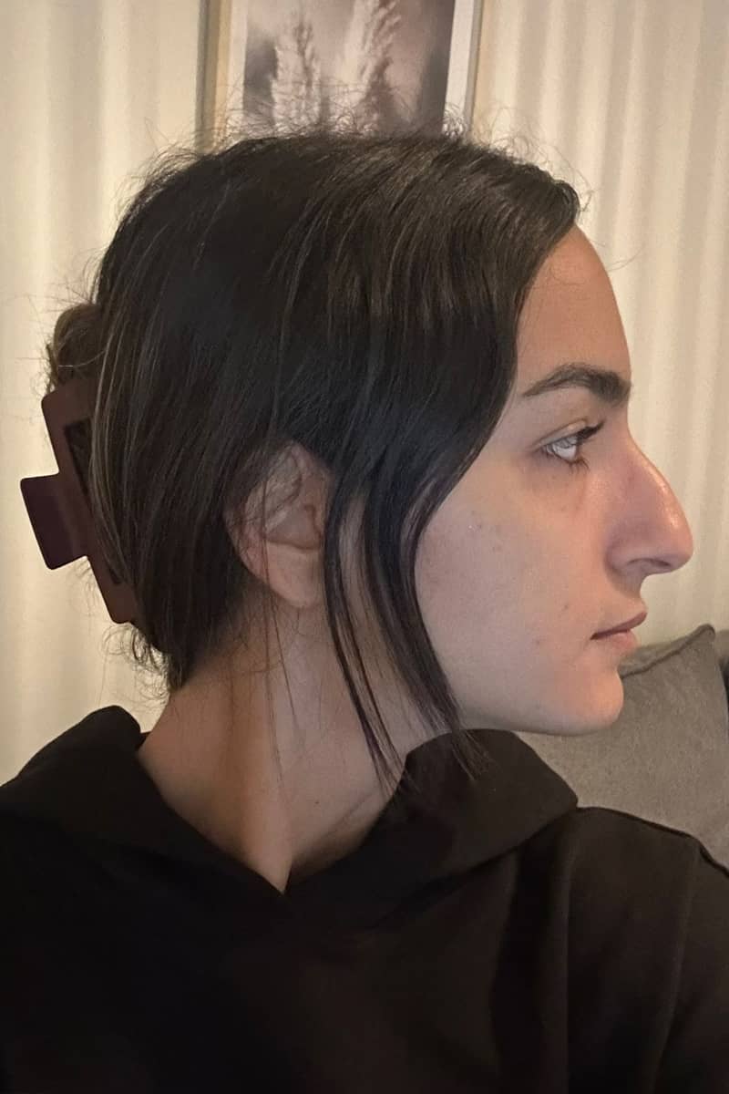Rhinoplastie Tunisie