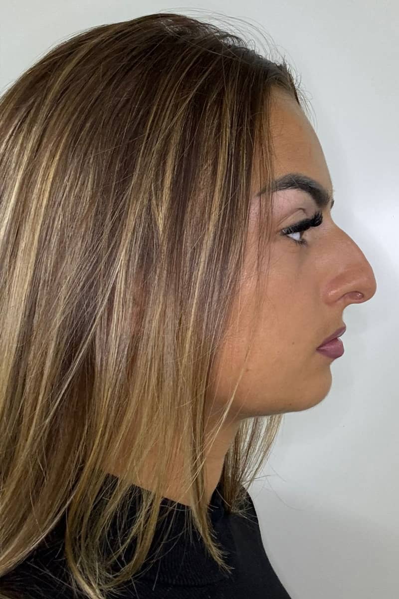 Rhinoplastie Tunisie