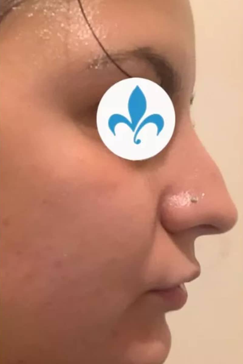 Rhinoplastie Tunisie