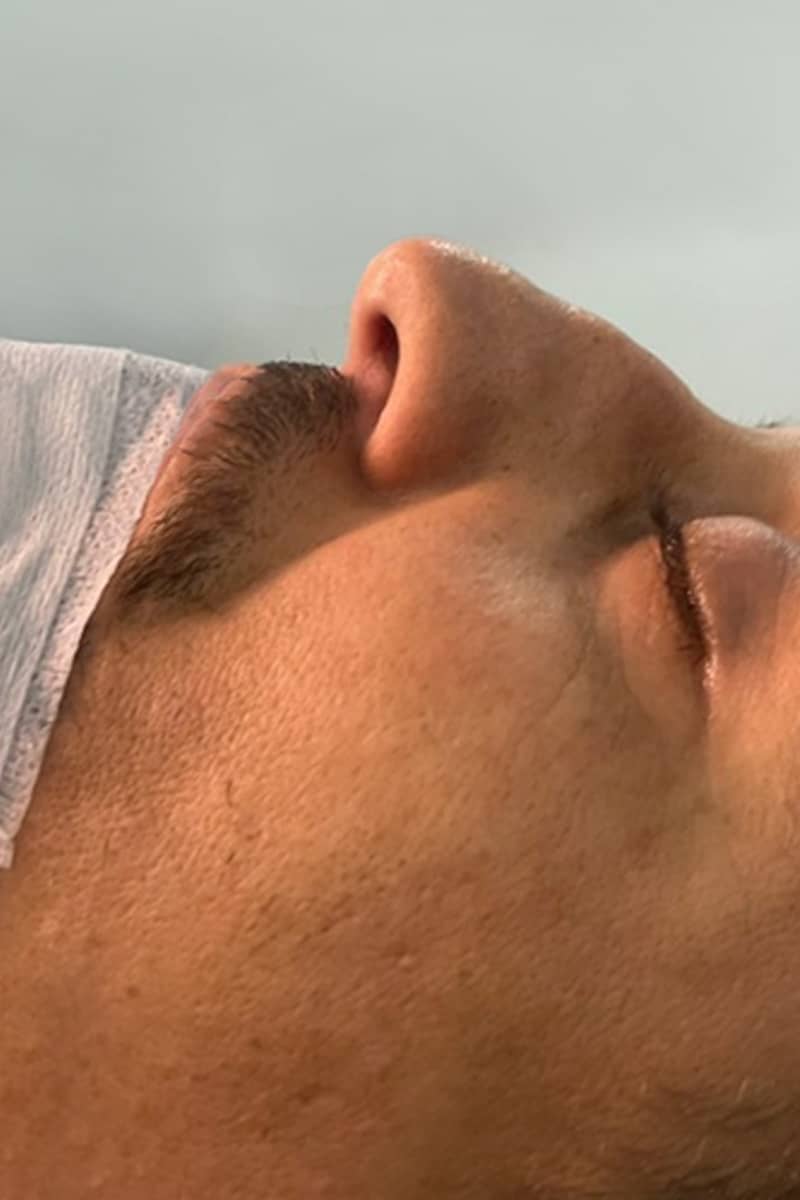 Rhinoplastie Tunisie